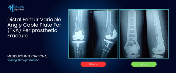 Tka Rim Plate Periprosthetic Distal Femur Fracture Fixation Using Variable Angle ...