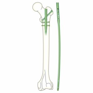 Femur Interlocking Nail
