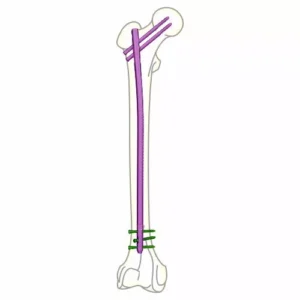 Advance Femur Nail GT