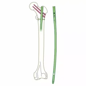 Antegrade Femur Interlocking Nail