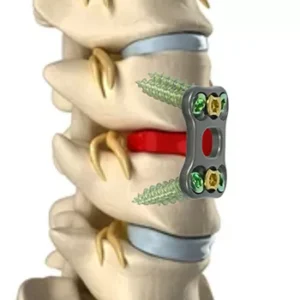 Anterior Cervical System