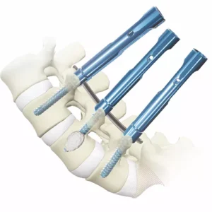 MIS Pedicle Screw System – Fenestrated