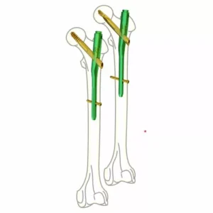 TFA Interlocking Nail