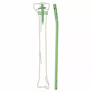 Tibia Interlocking Nail