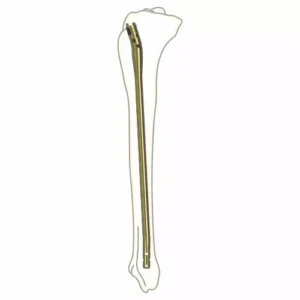 Tibia nail Suprapatellar