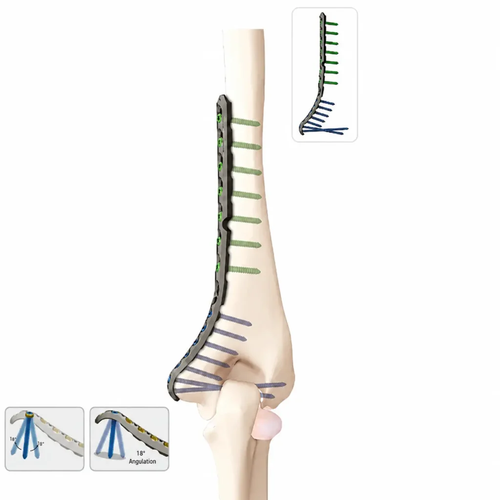 VA Locking Medial Distal Humerus Plate