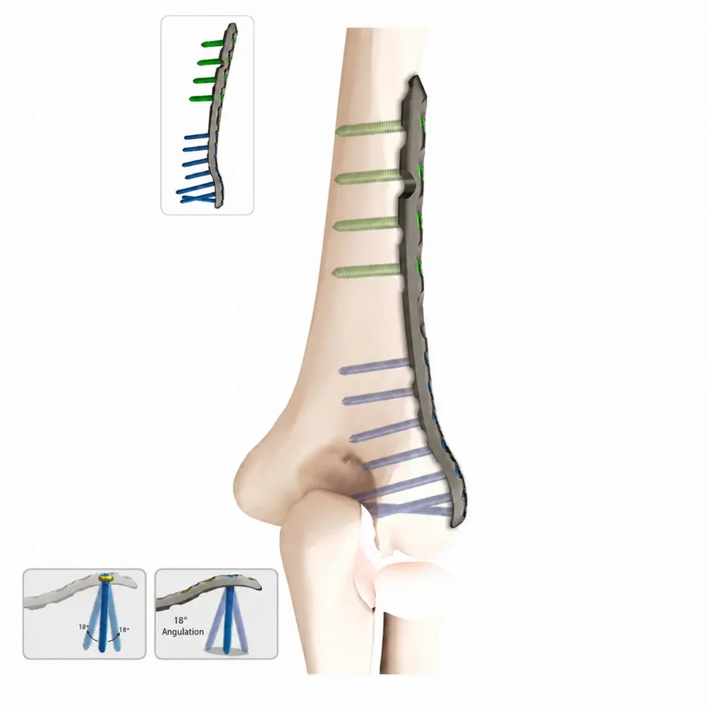 VA Locking Distal Humerus Plate, Lateral