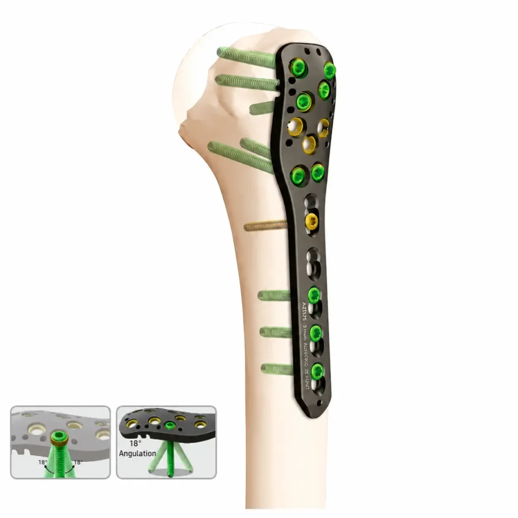 VA Locking Proximal Humerus Plate