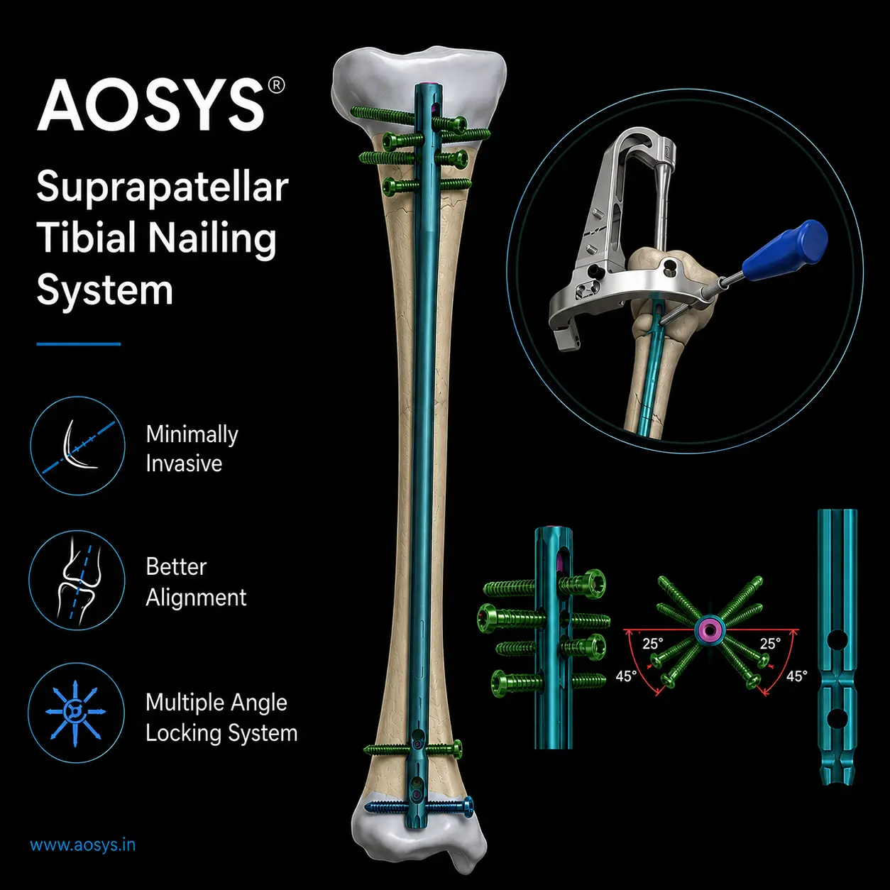 Home 2 Suprapatellar Tibial Nailing System